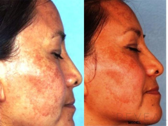 Before & After Skin Care Case 126 View #2 View in San Jose, CA