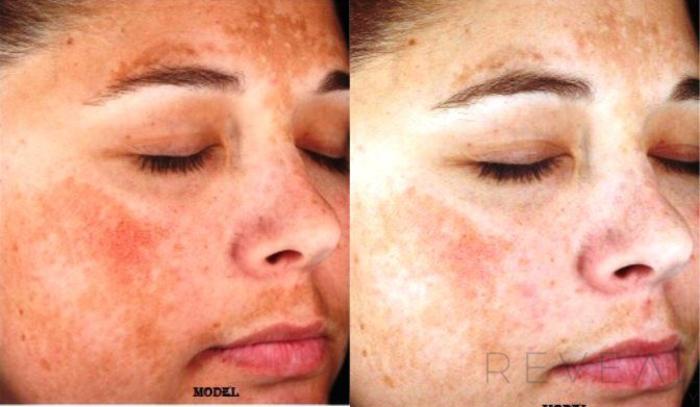 Before & After Skin Care Case 126 View #3 View in San Jose, CA