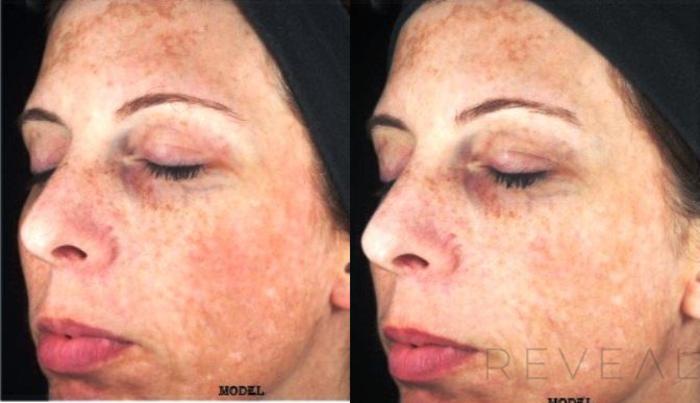 Before & After Skin Care Case 126 View #4 View in San Jose, CA