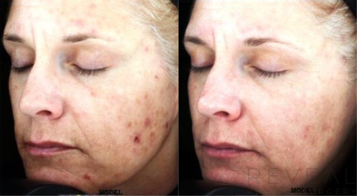 Before & After Skin Care Case 127 View #1 View in San Jose, CA
