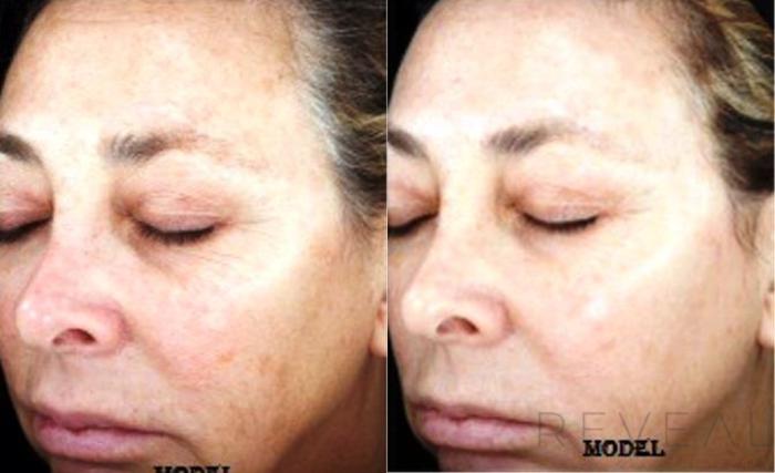 Before & After Skin Care Case 127 View #2 View in San Jose, CA