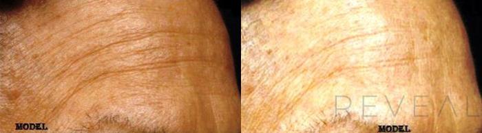 Before & After Skin Care Case 128 View #5 View in San Jose, CA