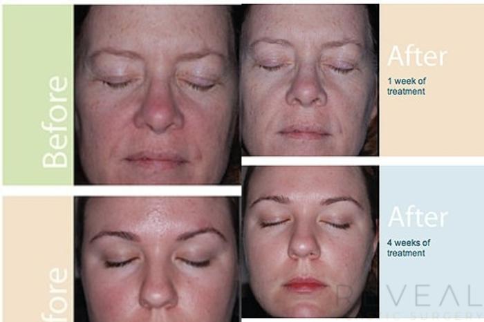 Before & After Skin Care Case 28 View #1 View in San Jose, CA