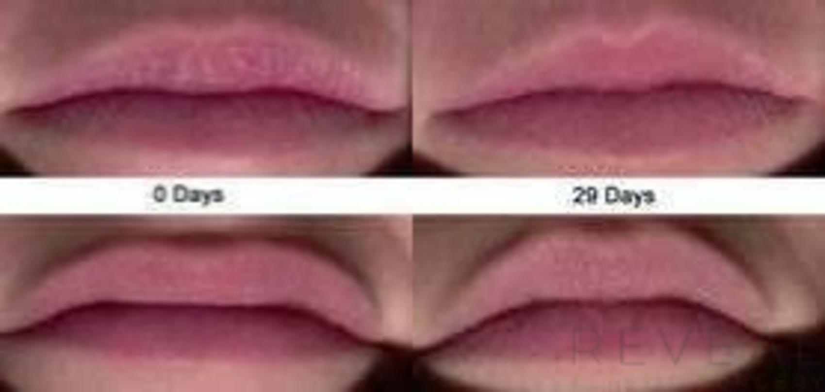 Before & After Peels & Resurfacing Case 29 View #1 View in San Jose, CA