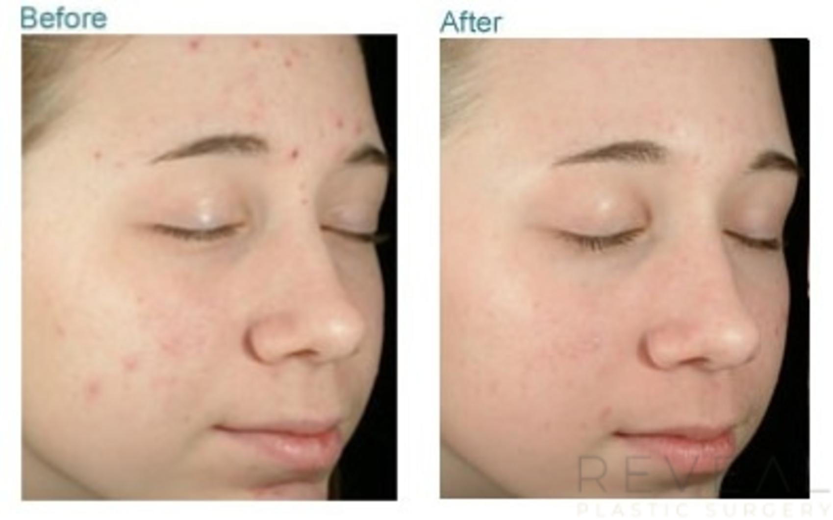 Before & After Peels & Resurfacing Case 35 View #1 View in San Jose, CA