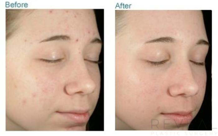Before & After Skin Care Case 35 View #1 View in San Jose, CA