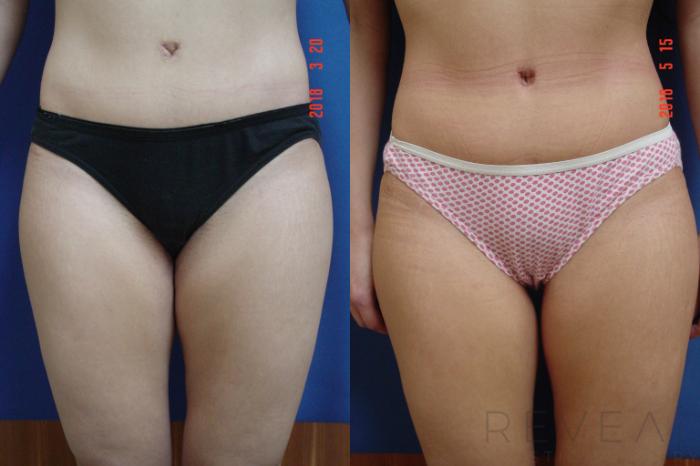 Before & After Thigh Lift Case 249 View #1 View in San Jose, CA