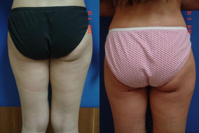 Before & After Thigh Lift Case 249 View #2 View in San Jose, CA