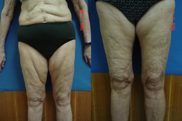 Before & After Thigh Lift Case 450 View #1 View in San Jose, CA