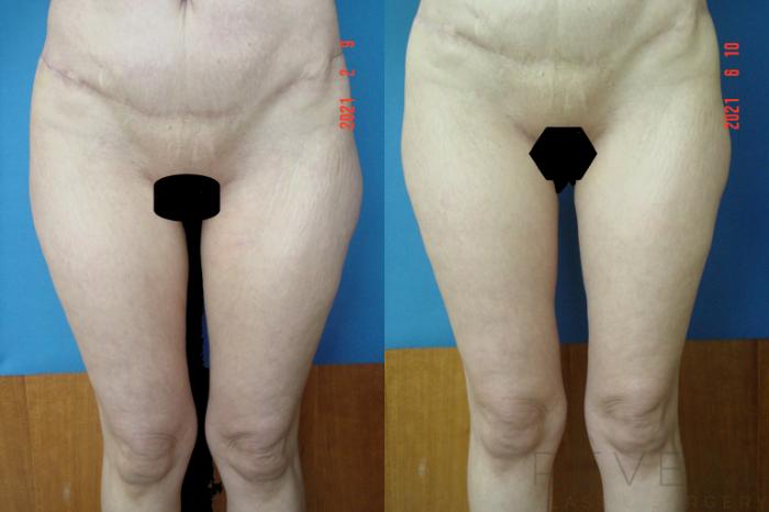 Before & After Thigh Lift Case 563 View #1 View in San Jose, CA