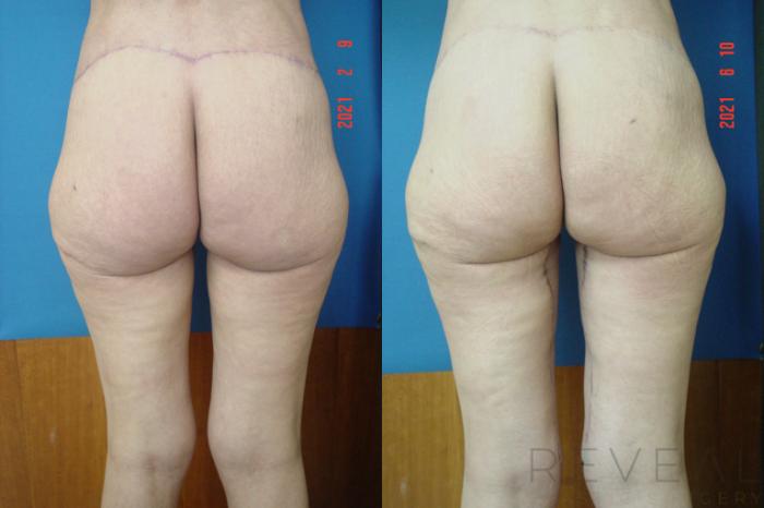 Before & After Thigh Lift Case 563 View #2 View in San Jose, CA