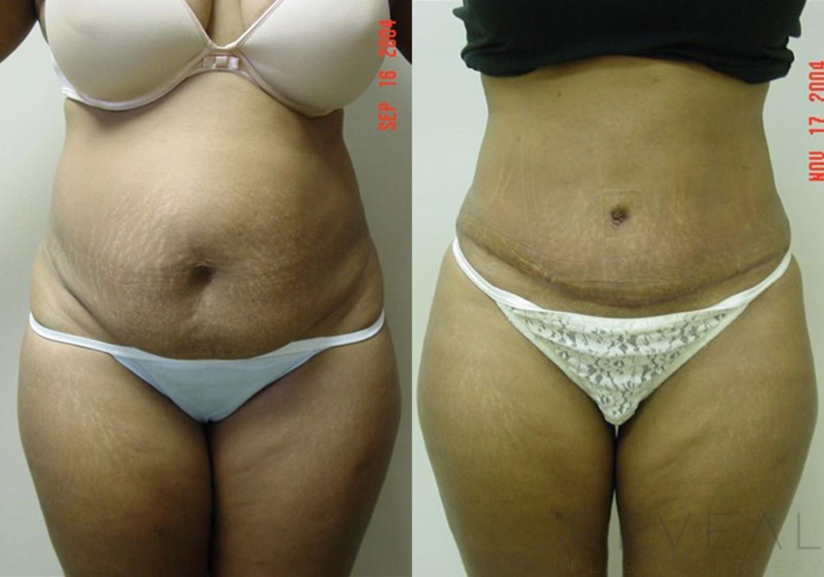 Before & After Liposuction Case 1 View #1 View in San Jose, CA