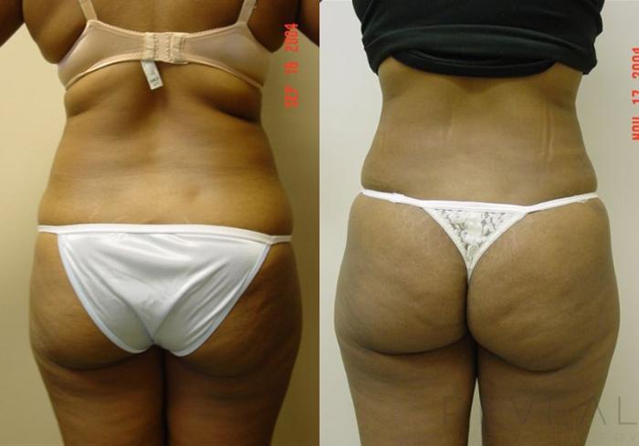 Before & After Tummy Tuck Case 1 View #2 View in San Jose, CA