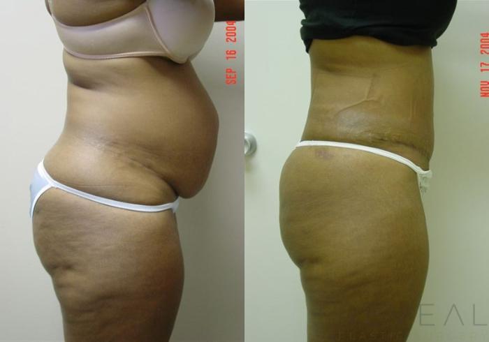 Before & After Liposuction Case 1 View #3 View in San Jose, CA