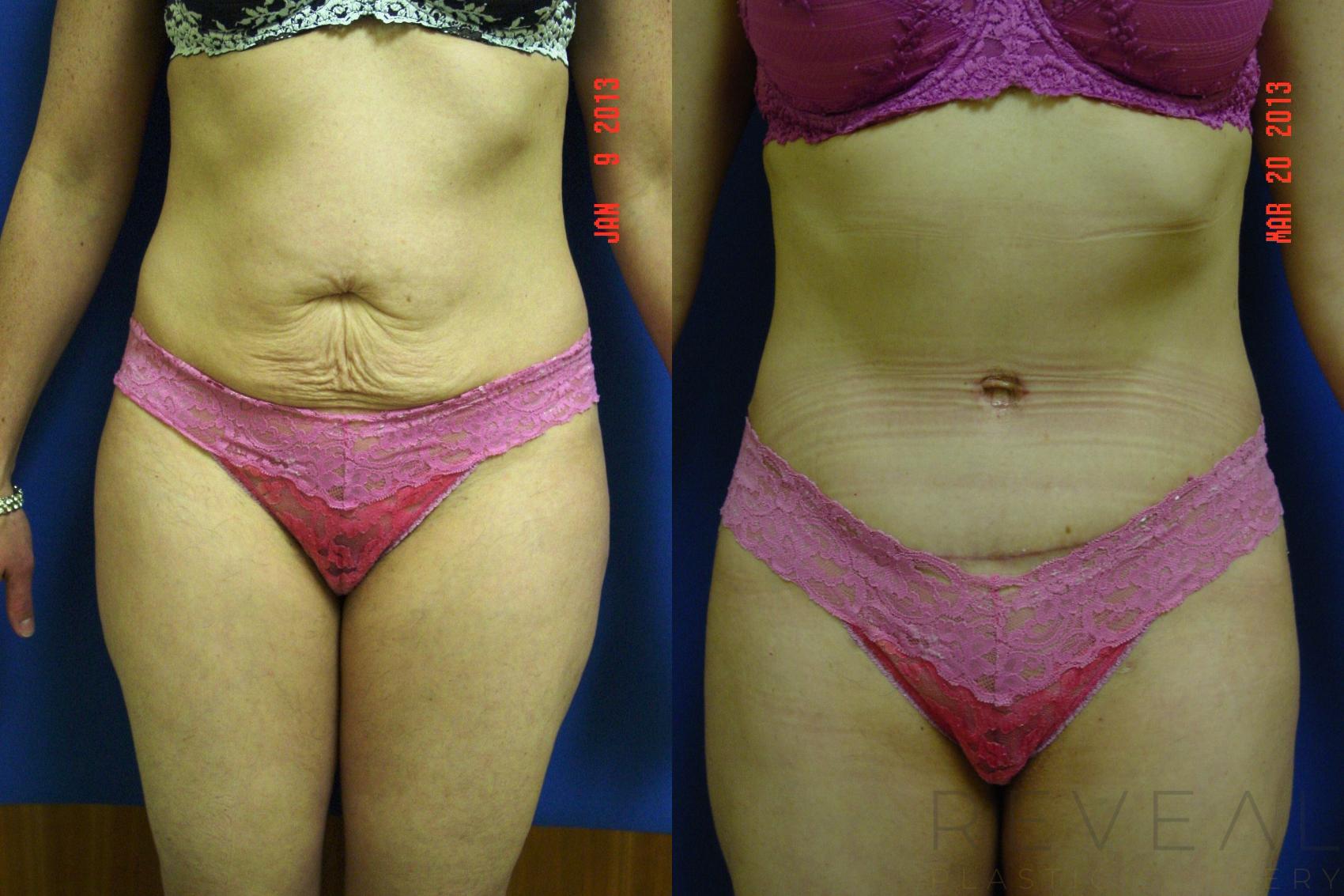 Before & After Liposuction Case 109 View #1 View in San Jose, CA