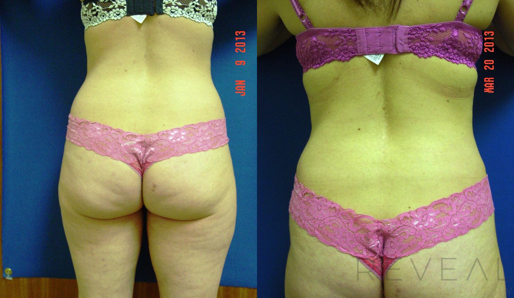 Before & After Liposuction Case 109 View #2 View in San Jose, CA