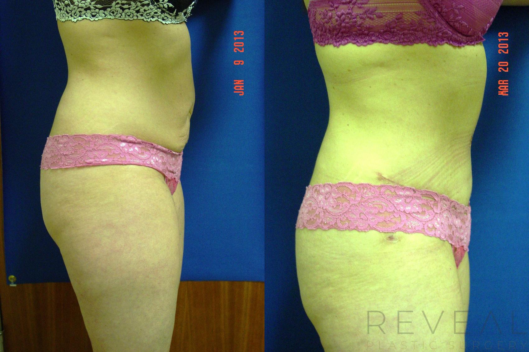 Before & After Liposuction Case 109 View #3 View in San Jose, CA