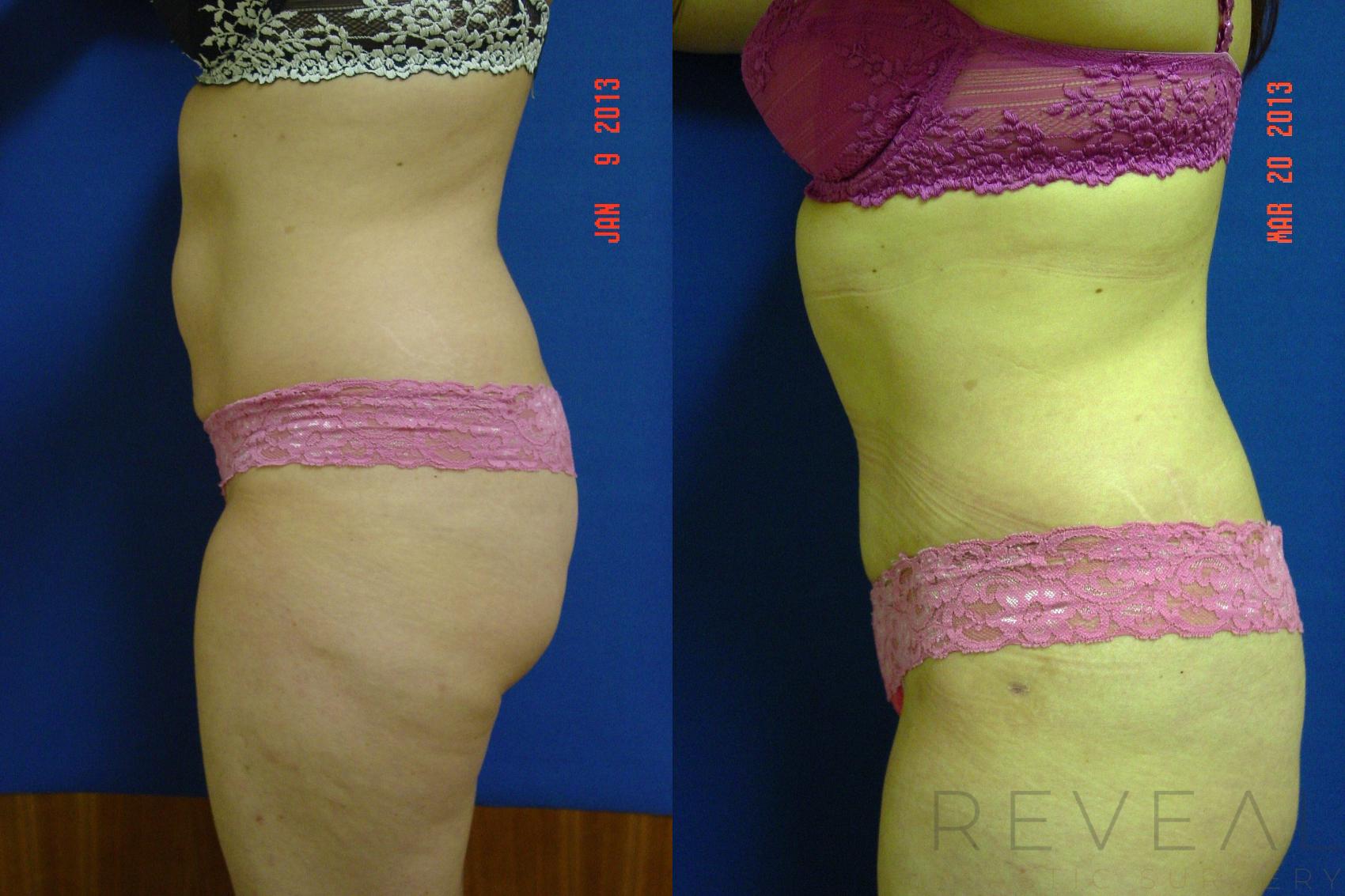Before & After Liposuction Case 109 View #4 View in San Jose, CA