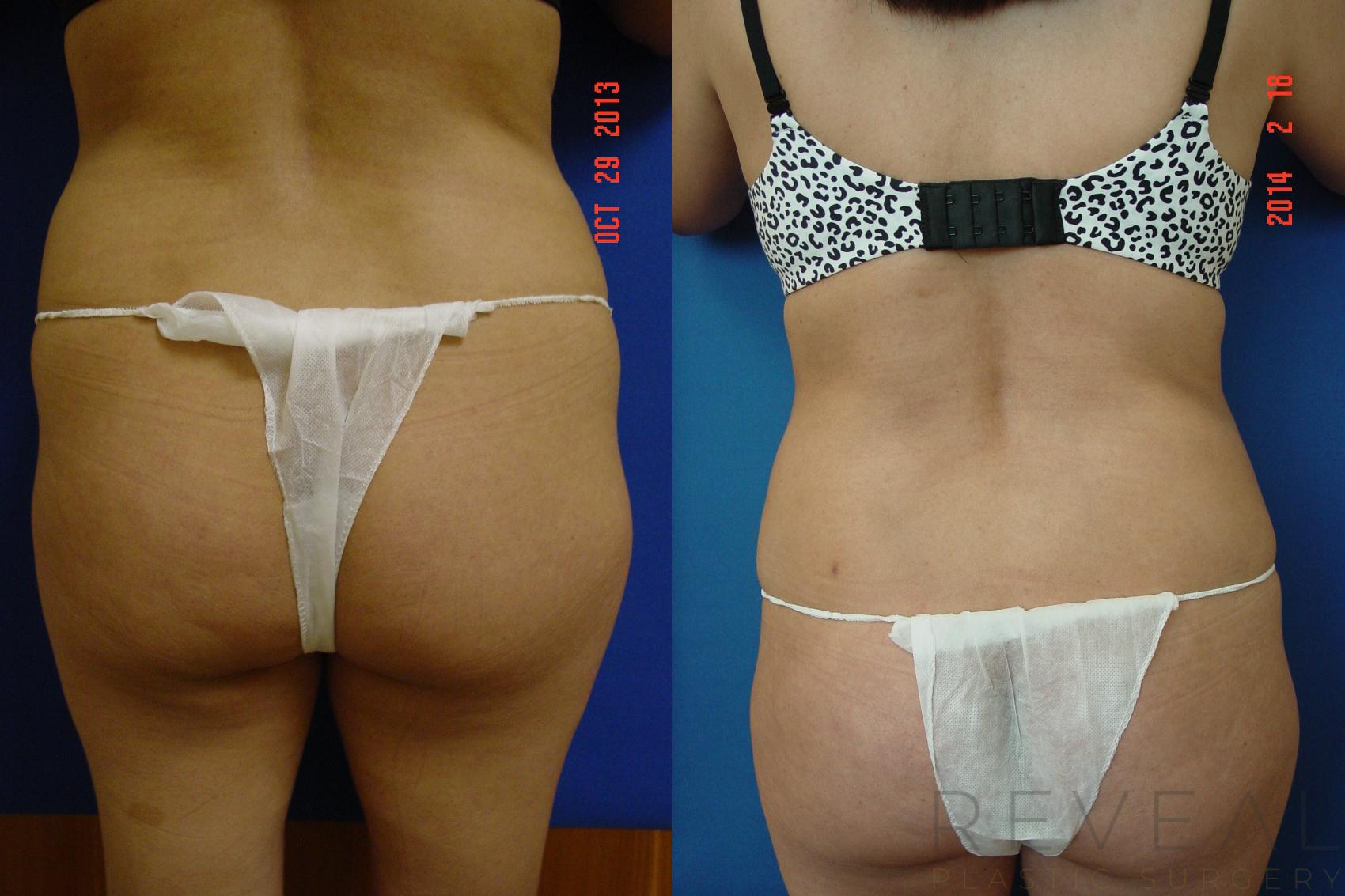 Before & After Liposuction Case 130 View #2 View in San Jose, CA
