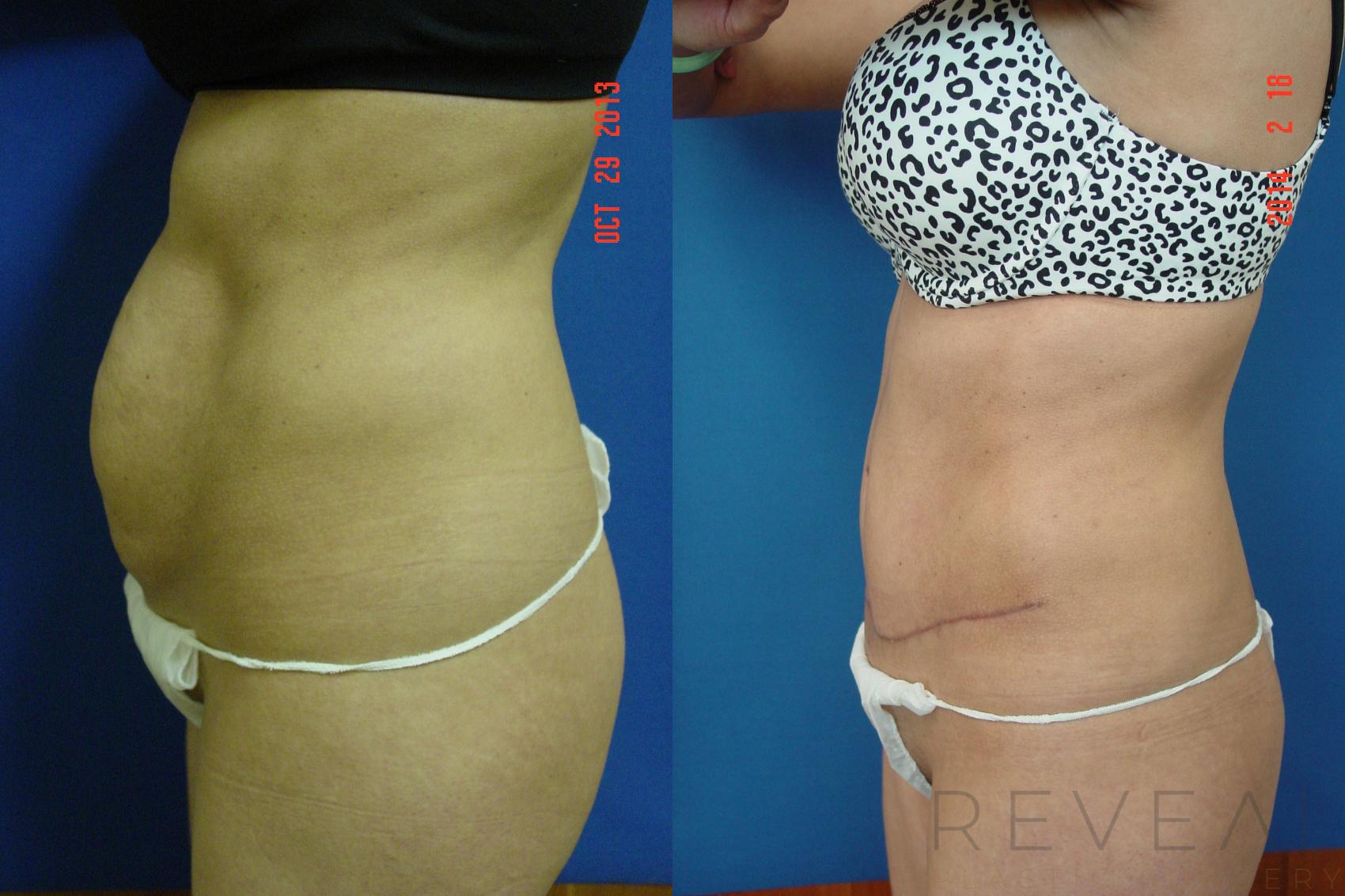 Before & After Liposuction Case 130 View #3 View in San Jose, CA