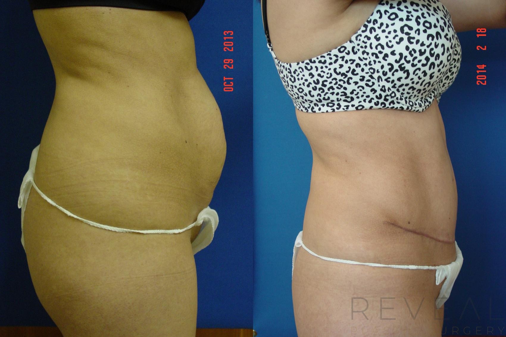 Before & After Liposuction Case 130 View #4 View in San Jose, CA