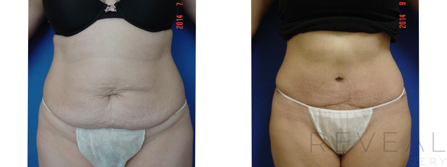Before & After Tummy Tuck Case 159 View #1 View in San Jose, CA