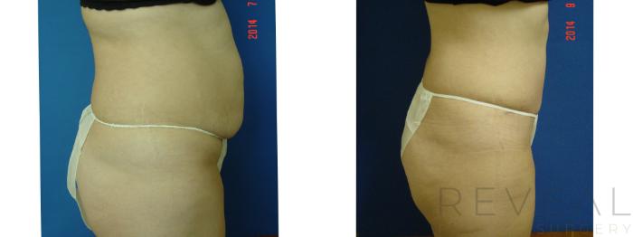 Before & After Tummy Tuck Case 159 View #3 View in San Jose, CA