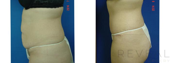 Before & After Liposuction Case 159 View #4 View in San Jose, CA