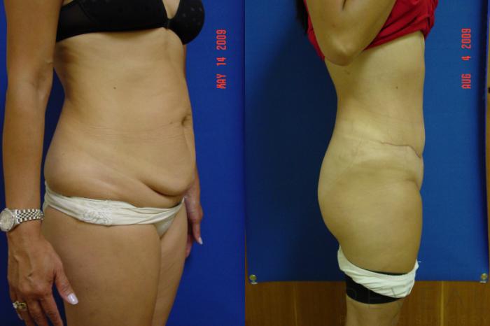 Before & After Tummy Tuck Case 16 View #1 View in San Jose, CA