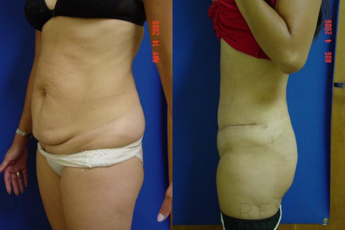 Before & After Tummy Tuck Case 16 View #2 View in San Jose, CA