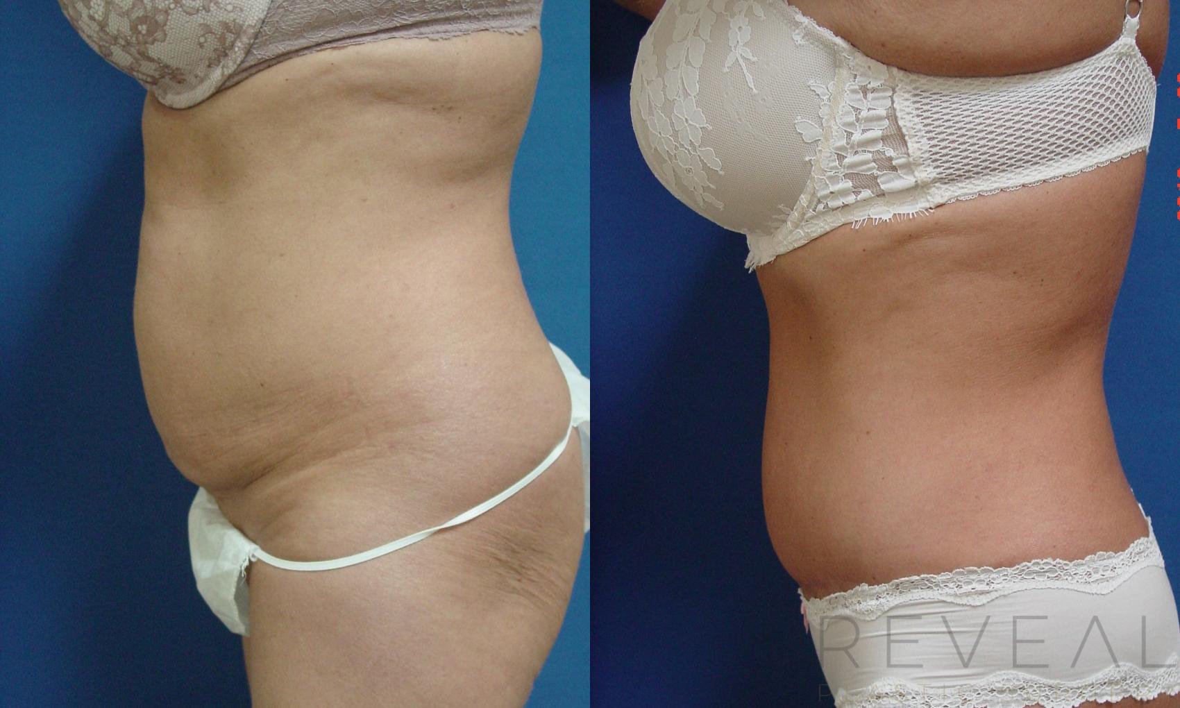 Before & After Liposuction Case 192 View #1 View in San Jose, CA