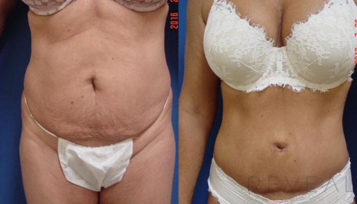 Before & After Tummy Tuck Case 192 View #2 View in San Jose, CA