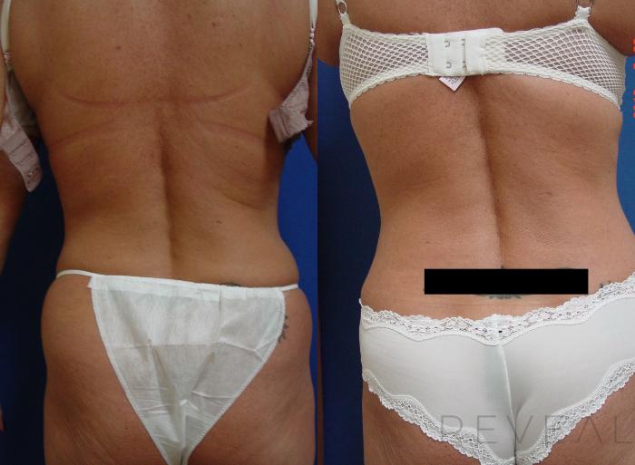 Before & After Liposuction Case 192 View #3 View in San Jose, CA