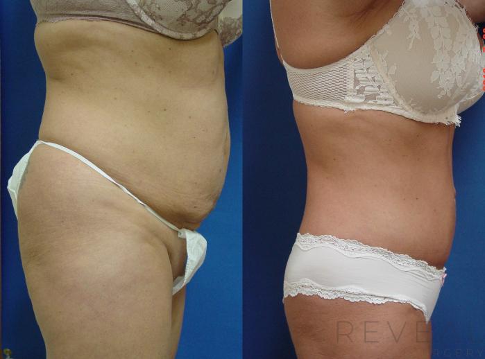 Before & After Liposuction Case 192 View #4 View in San Jose, CA