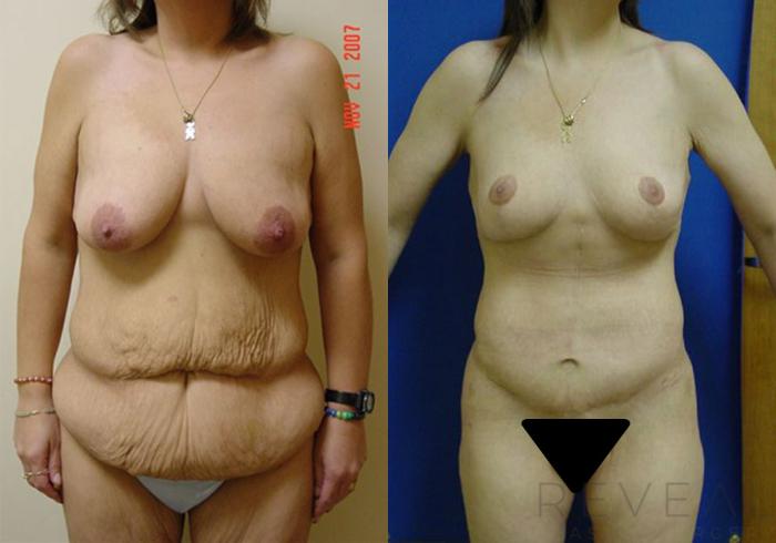 Before & After Tummy Tuck Case 2 View #1 View in San Jose, CA