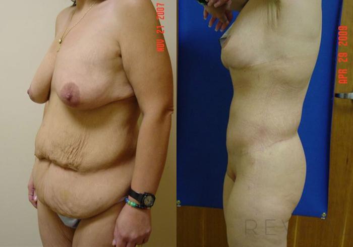Before & After Tummy Tuck Case 2 View #2 View in San Jose, CA