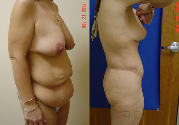 Before & After Liposuction Case 2 View #3 View in San Jose, CA