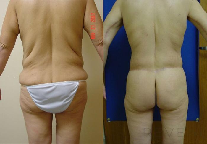 Before & After Liposuction Case 2 View #4 View in San Jose, CA