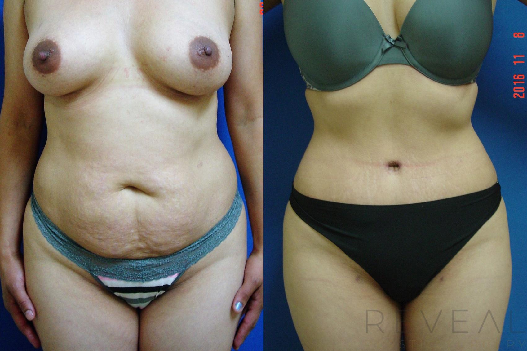Before & After Tummy Tuck Case 201 View #1 View in San Jose, CA