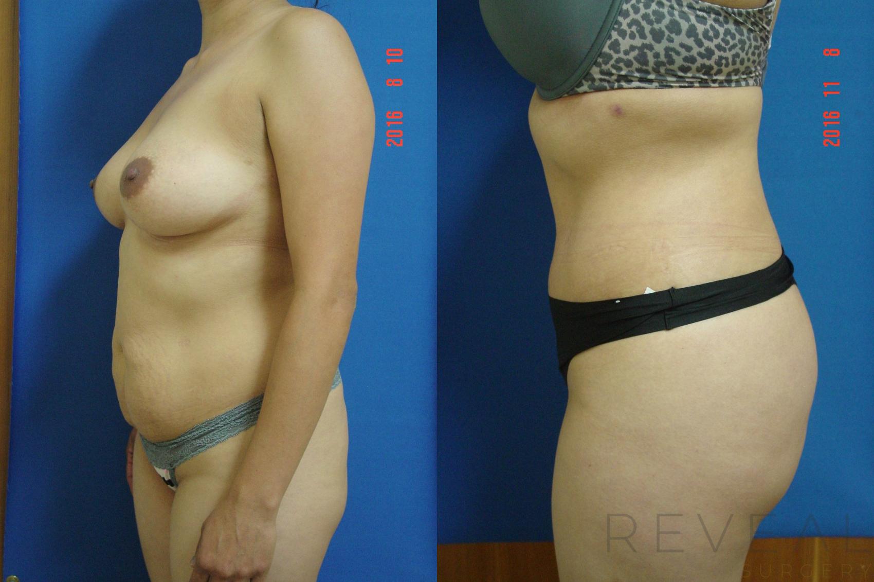 Before & After Tummy Tuck Case 201 View #2 View in San Jose, CA