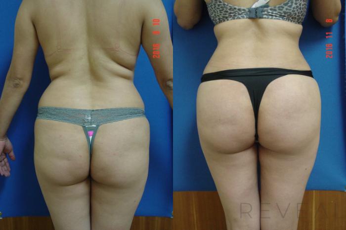 Before & After Brazilian Butt Lift Case 201 View #3 View in San Jose, CA