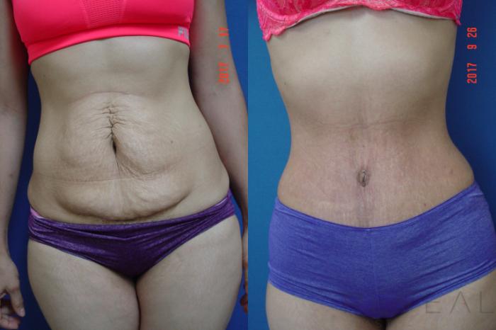 Before & After Liposuction Case 222 View #1 View in San Jose, CA