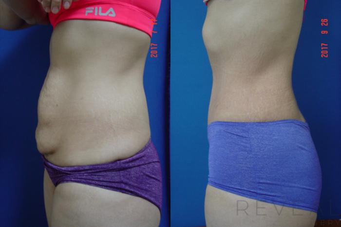 Before & After Tummy Tuck Case 222 View #2 View in San Jose, CA