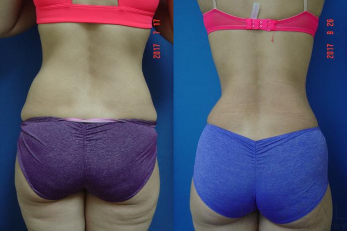Before & After Liposuction Case 222 View #3 View in San Jose, CA