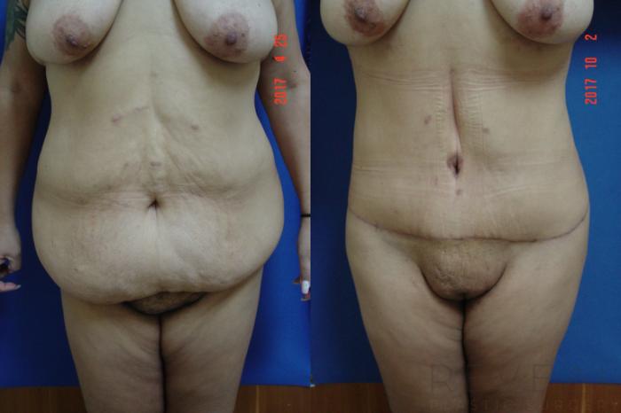 Before & After Tummy Tuck Case 226 View #1 View in San Jose, CA