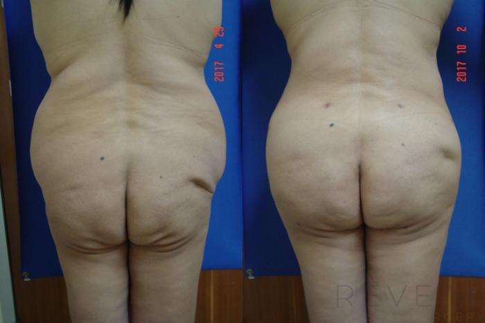 Before & After Tummy Tuck Case 226 View #2 View in San Jose, CA