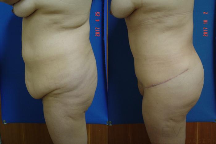 Before & After Tummy Tuck Case 226 View #3 View in San Jose, CA