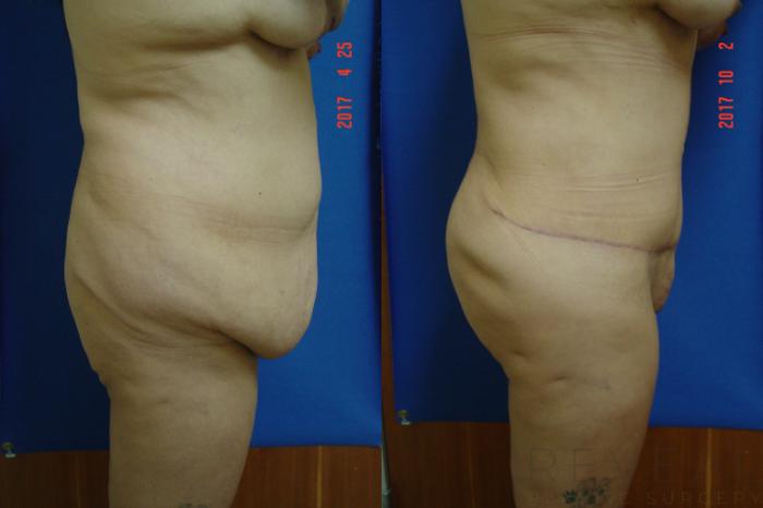 Before & After Brazilian Butt Lift Case 226 View #4 View in San Jose, CA
