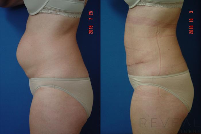 Before & After Tummy Tuck Case 260 View #1 View in San Jose, CA