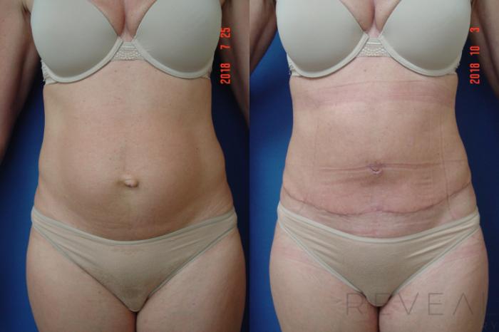 Before & After Tummy Tuck Case 260 View #2 View in San Jose, CA